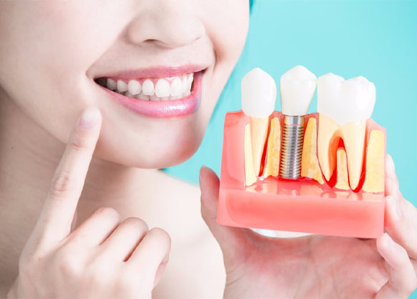 Dental Implants in St Kilda: What Patients Should Know
