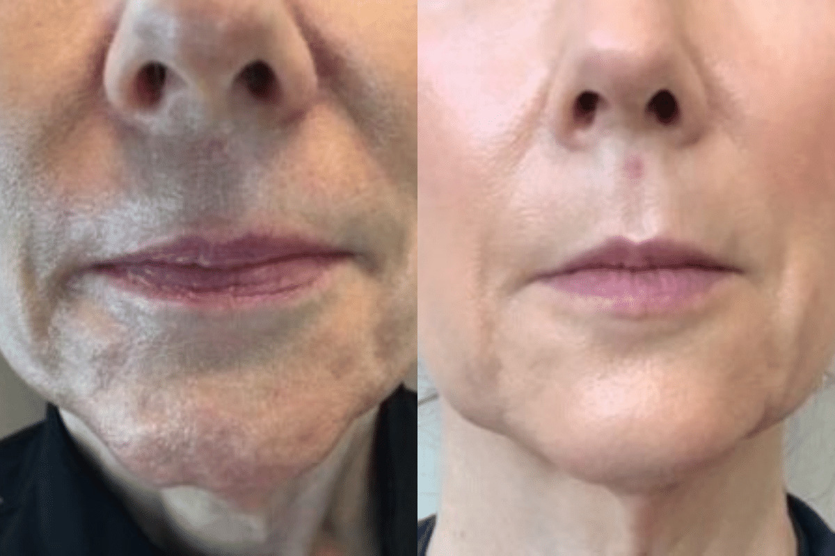 Who Is Ideal for Chin Botox Before and After Results?