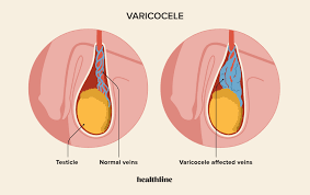 Low-cost Varicocele Embolization cost in India by Dr. Sandeep Sharma | IRfacilities