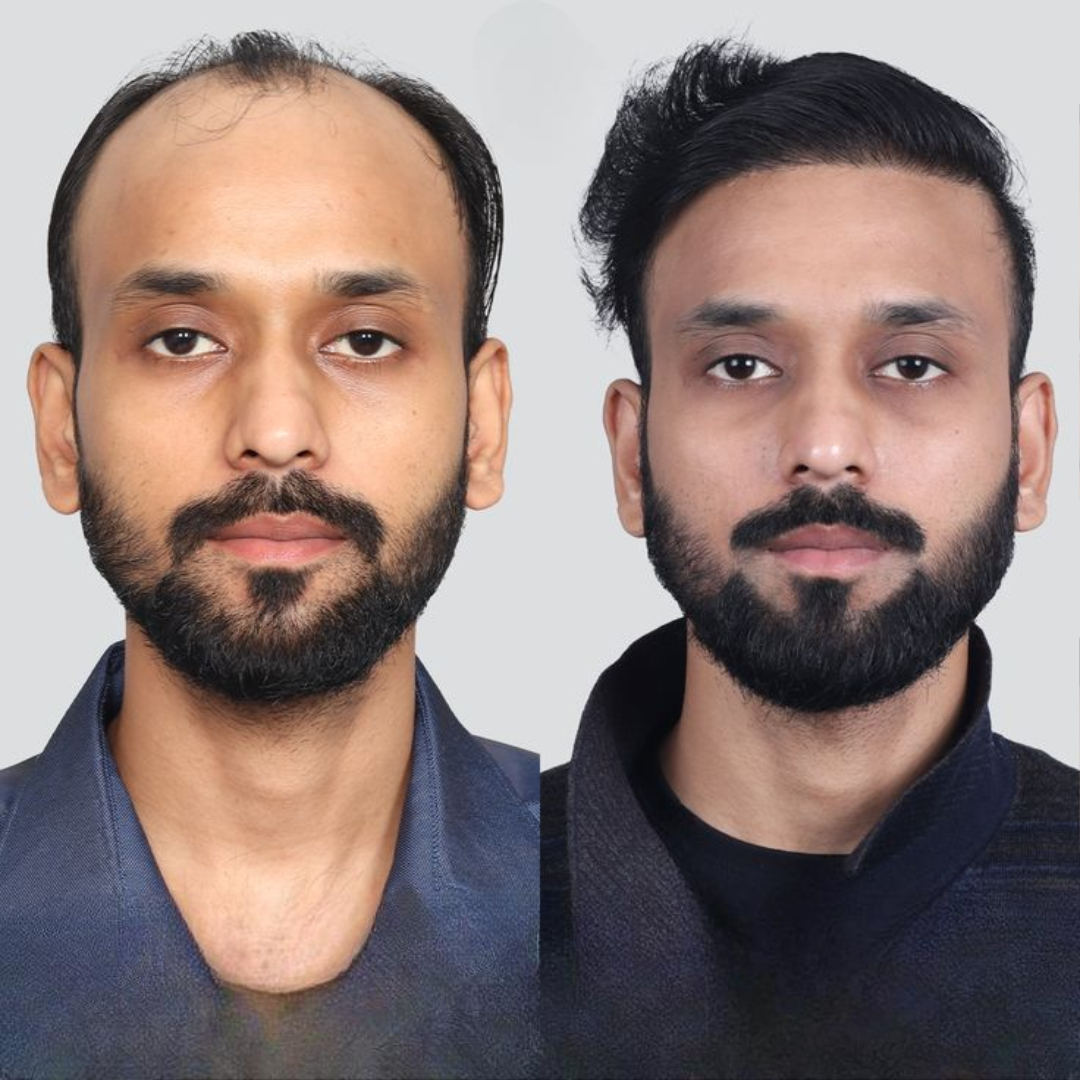 Hair Transplant in Islamabad: Understanding Cost, Value, and Long-Term Benefits