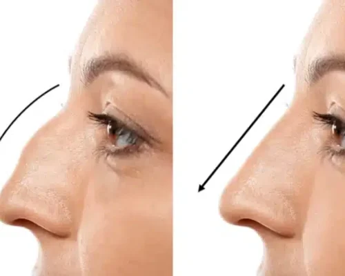 Rhinoplasty in Lahore: Expert Nose Surgery for Natural and Confident Results