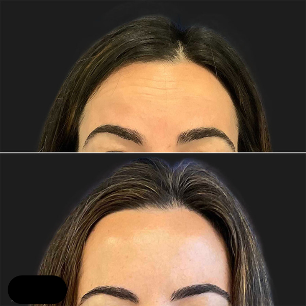How Long Does 20 Units of Botox Last for Forehead?